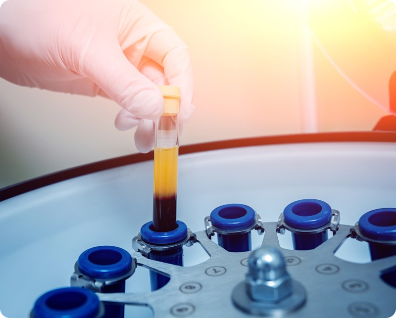Beneficiile infiltratiilor cu plasma. În ce constă aceasta terapie?